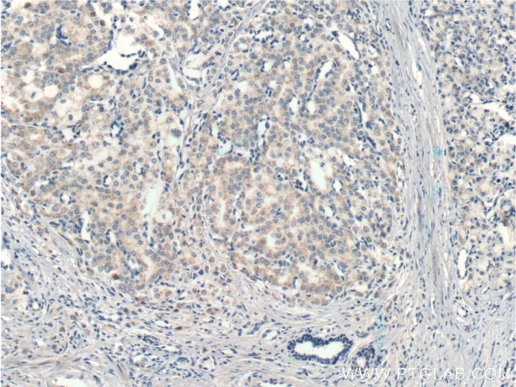 Immunohistochemistry (IHC) staining of human prostate cancer tissue using RDH11 Polyclonal antibody (11077-1-AP)