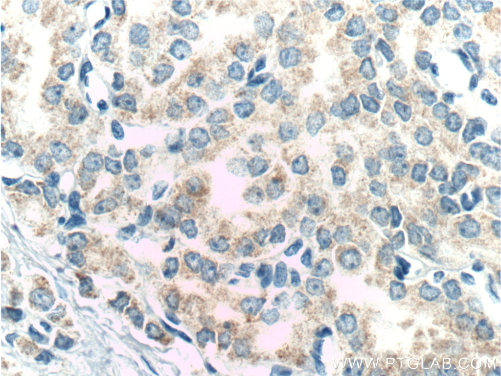 Immunohistochemistry (IHC) staining of human prostate cancer tissue using RDH11 Polyclonal antibody (11077-1-AP)