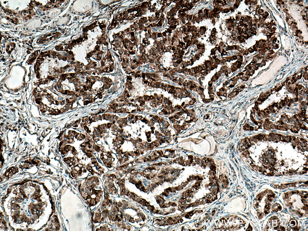 Immunohistochemistry (IHC) staining of human thyroid cancer tissue using RDM1 Monoclonal antibody (66941-1-Ig)