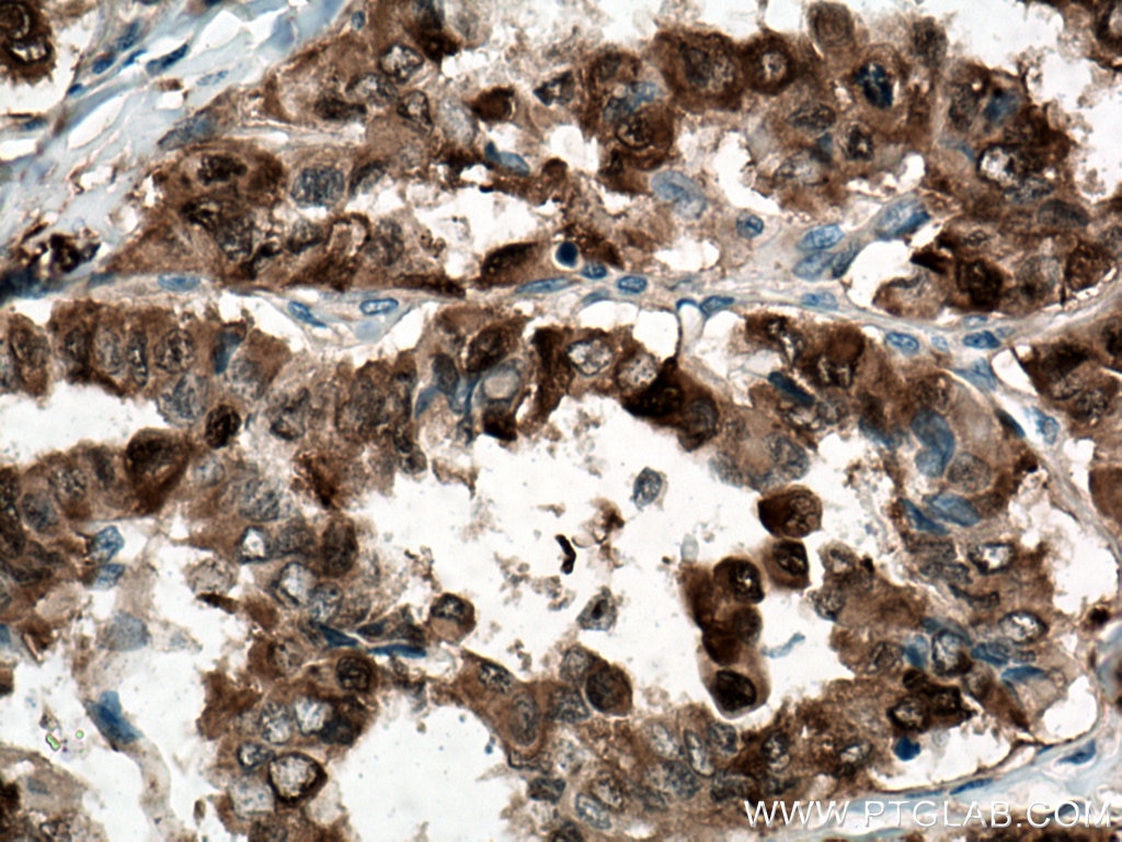 Immunohistochemistry (IHC) staining of human thyroid cancer tissue using RDM1 Monoclonal antibody (66941-1-Ig)