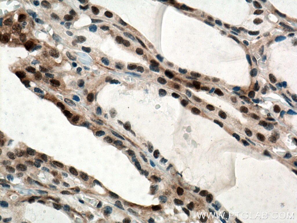 Immunohistochemistry (IHC) staining of human thyroid cancer tissue using RDM1 Monoclonal antibody (66941-1-Ig)