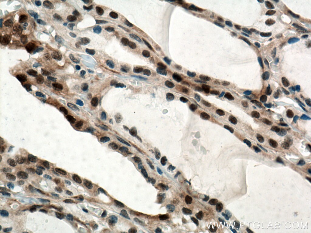 IHC staining of human thyroid cancer using 66941-1-Ig