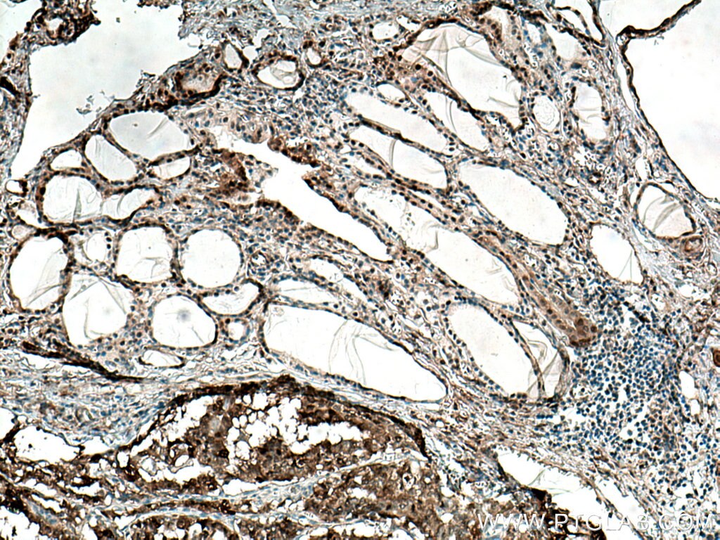 Immunohistochemistry (IHC) staining of human thyroid cancer tissue using RDM1 Monoclonal antibody (66941-1-Ig)