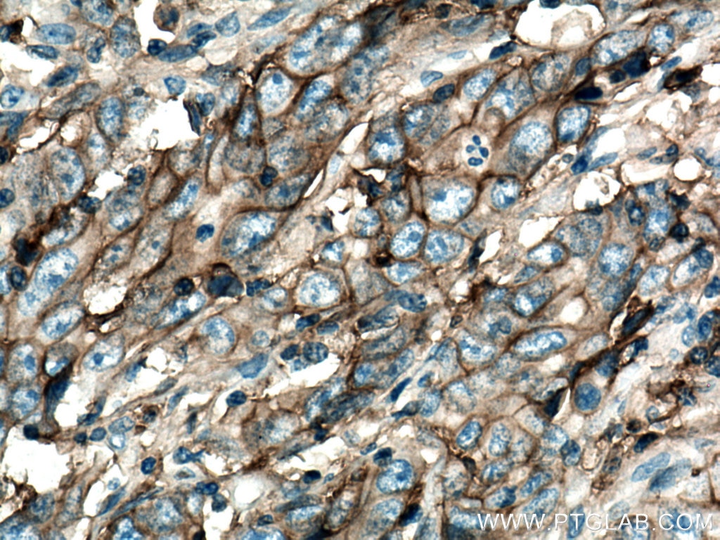 Immunohistochemistry (IHC) staining of human stomach cancer tissue using SLC1A5/ASCT2 Polyclonal antibody (20350-1-AP)