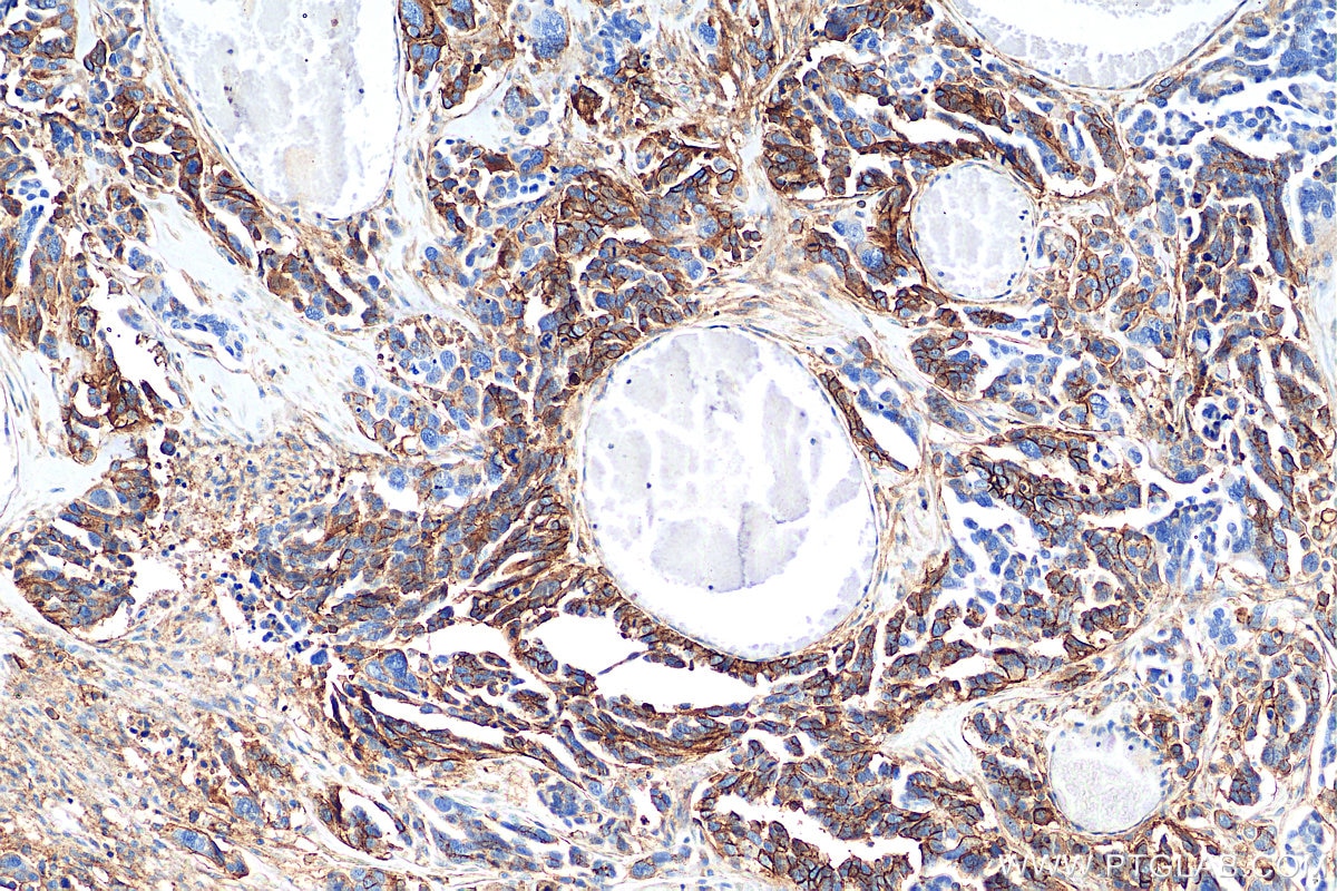 Immunohistochemistry (IHC) staining of human colon cancer tissue using SLC1A5/ASCT2 Polyclonal antibody (20350-1-AP)