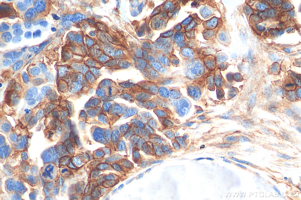 IHC staining of human colon cancer using 20350-1-AP