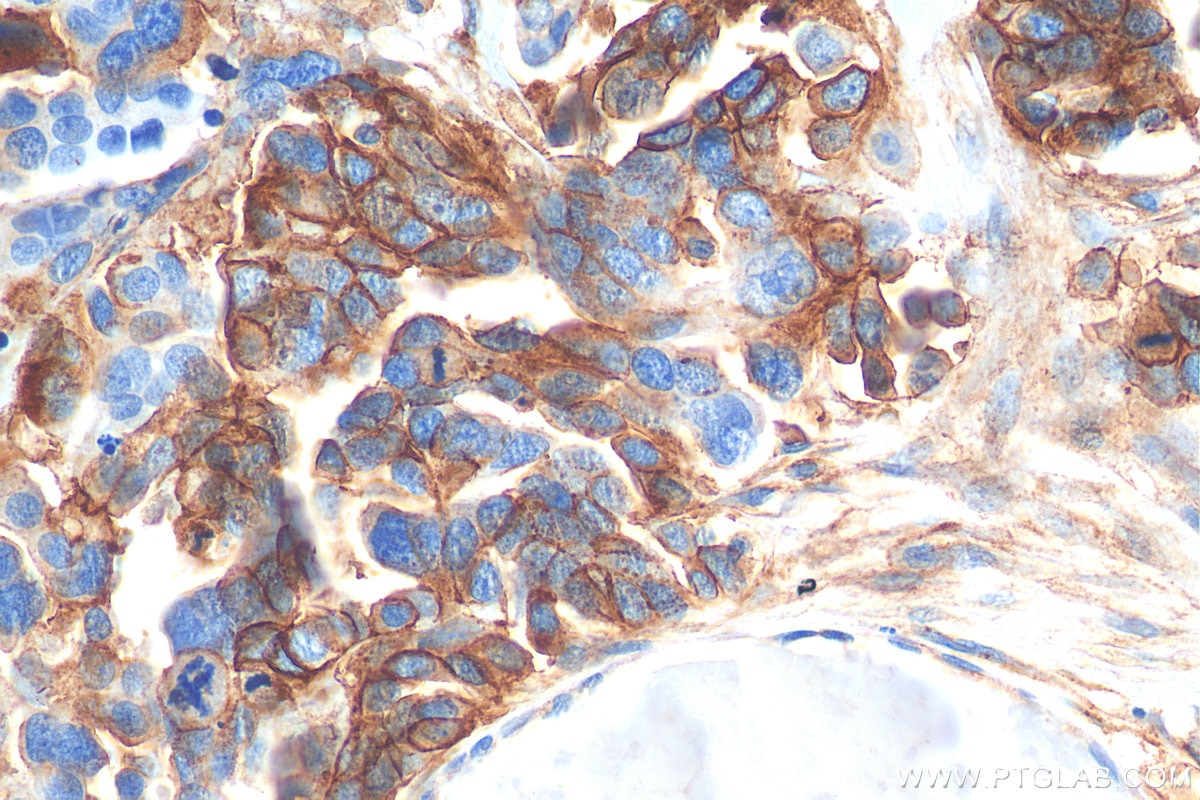 Immunohistochemistry (IHC) staining of human colon cancer tissue using SLC1A5/ASCT2 Polyclonal antibody (20350-1-AP)