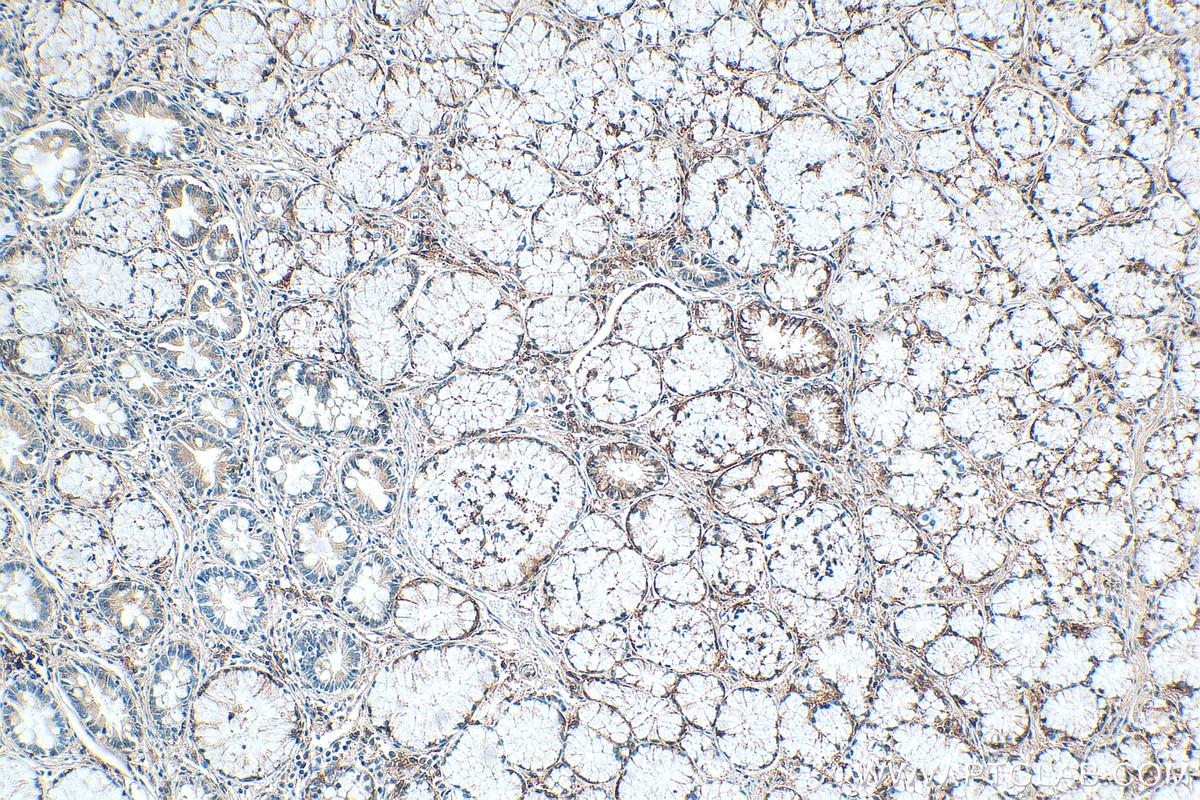 Immunohistochemistry (IHC) staining of human stomach cancer tissue using SLC1A5/ASCT2 Monoclonal antibody (68540-1-Ig)
