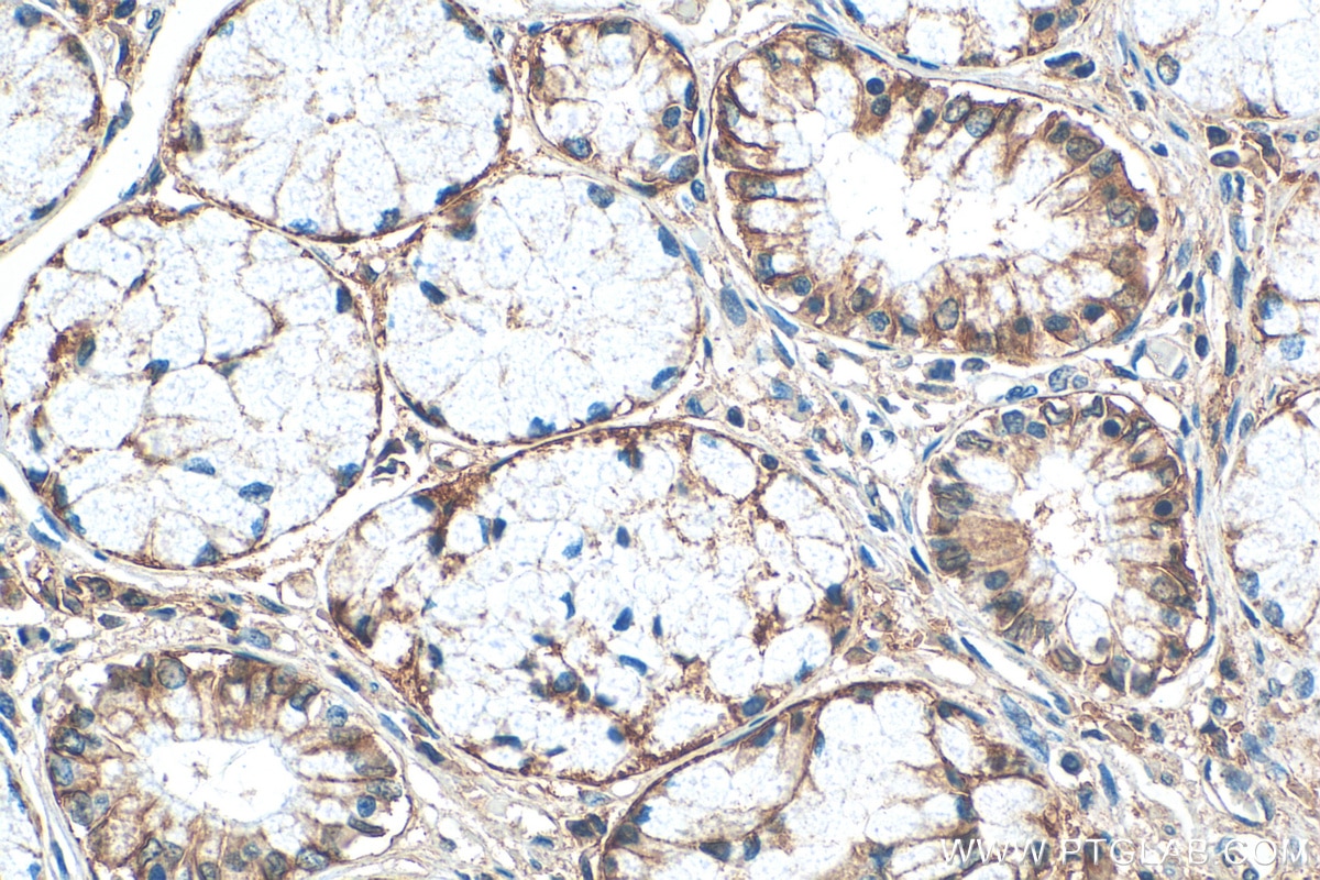 IHC staining of human stomach cancer using 68540-1-Ig