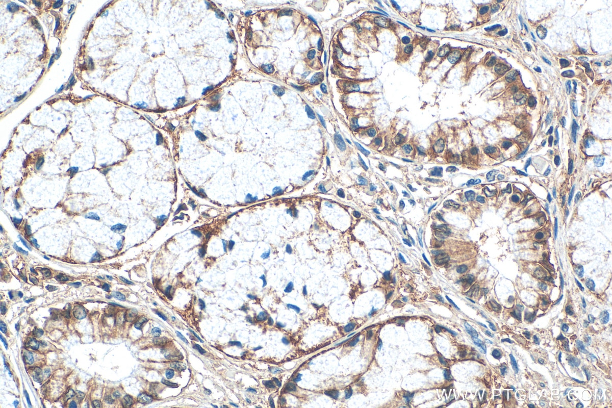 Immunohistochemistry (IHC) staining of human stomach cancer tissue using SLC1A5/ASCT2 Monoclonal antibody (68540-1-Ig)