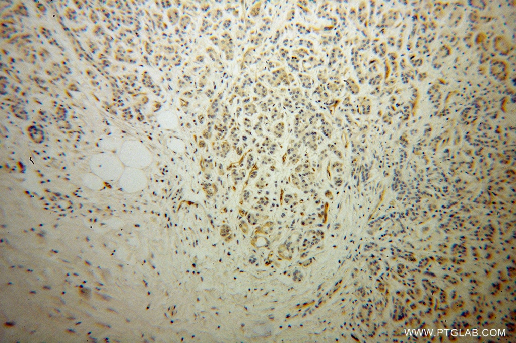 Immunohistochemistry (IHC) staining of human pancreas cancer tissue using Radixin Polyclonal antibody (13790-1-AP)