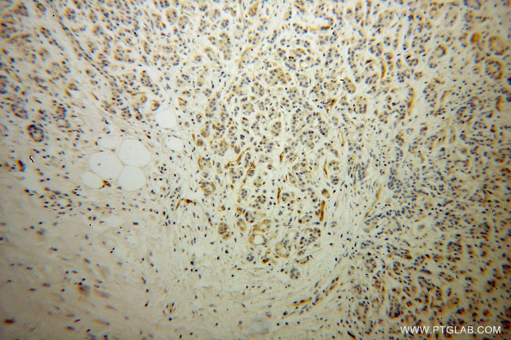 IHC staining of human pancreas cancer using 13790-1-AP