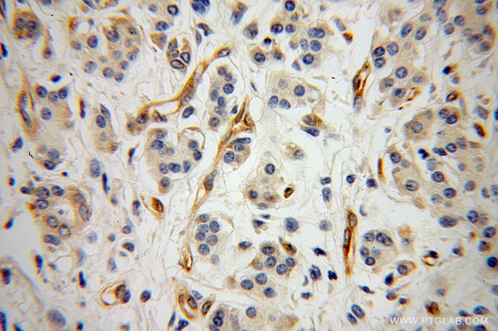 Immunohistochemistry (IHC) staining of human pancreas cancer tissue using Radixin Polyclonal antibody (13790-1-AP)