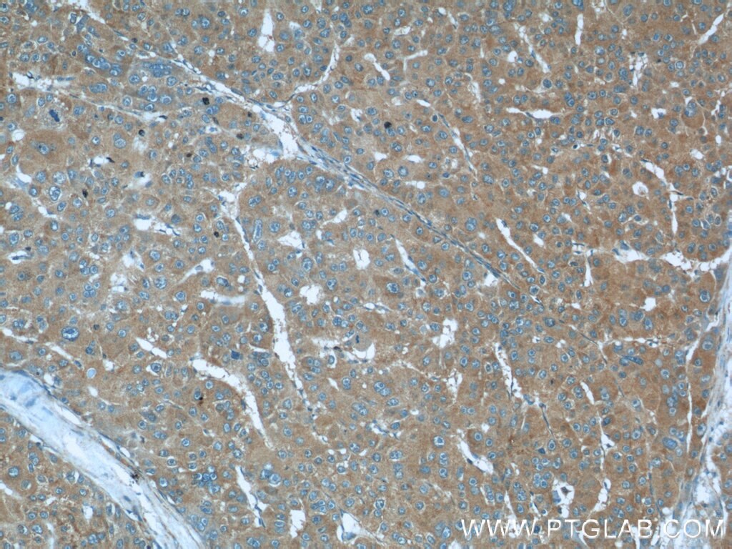 Immunohistochemistry (IHC) staining of human liver cancer tissue using Radixin Polyclonal antibody (13790-1-AP)