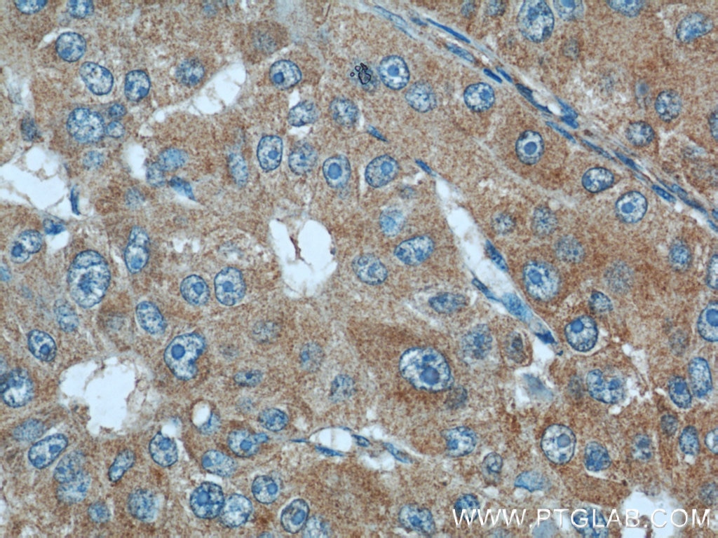 Immunohistochemistry (IHC) staining of human liver cancer tissue using Radixin Polyclonal antibody (13790-1-AP)