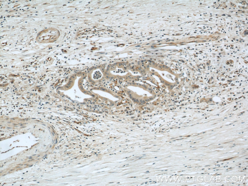 IHC staining of human pancreas cancer using 13790-1-AP