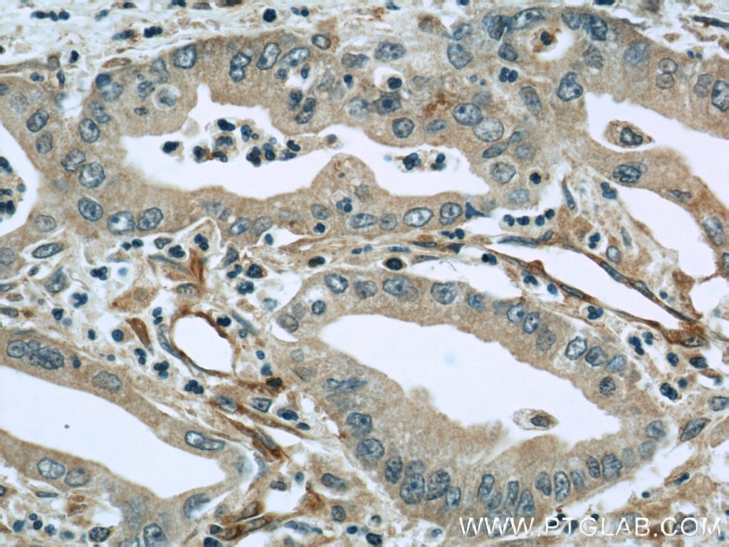 Immunohistochemistry (IHC) staining of human pancreas cancer tissue using Radixin Polyclonal antibody (13790-1-AP)