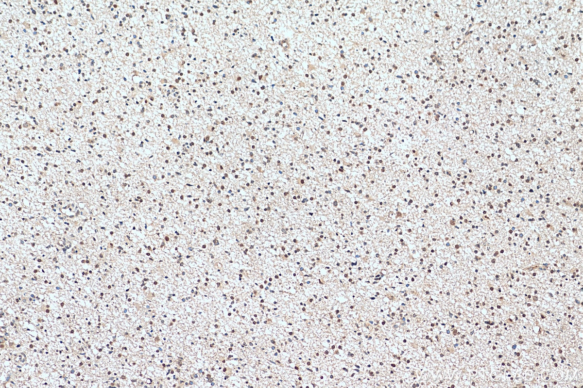 Immunohistochemistry (IHC) staining of human gliomas tissue using RECQL4 Polyclonal antibody (17008-1-AP)