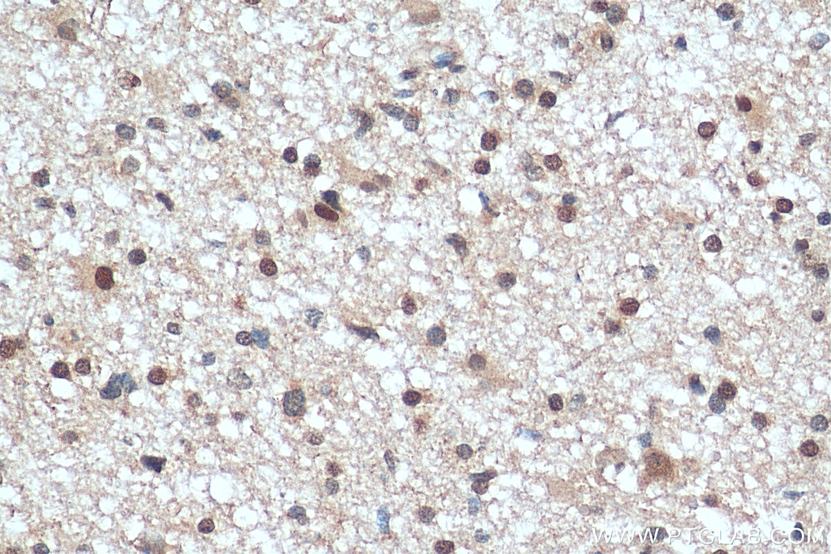 Immunohistochemistry (IHC) staining of human gliomas tissue using RECQL4 Polyclonal antibody (17008-1-AP)