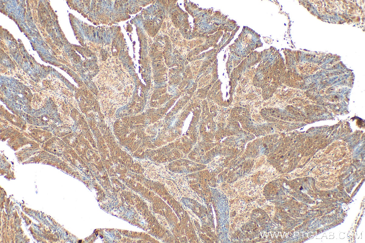 Immunohistochemistry (IHC) staining of human colon cancer tissue using RECQL4 Polyclonal antibody (17008-1-AP)