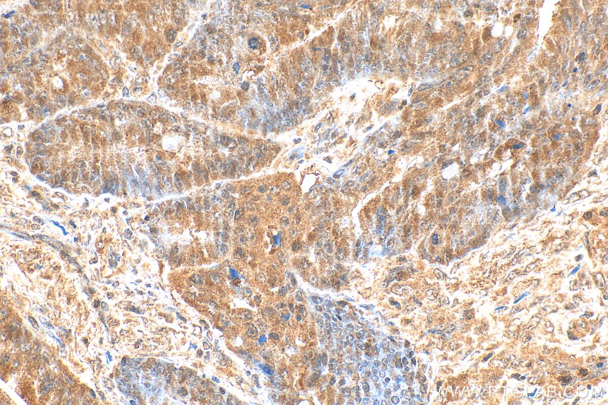 Immunohistochemistry (IHC) staining of human colon cancer tissue using RECQL4 Polyclonal antibody (17008-1-AP)