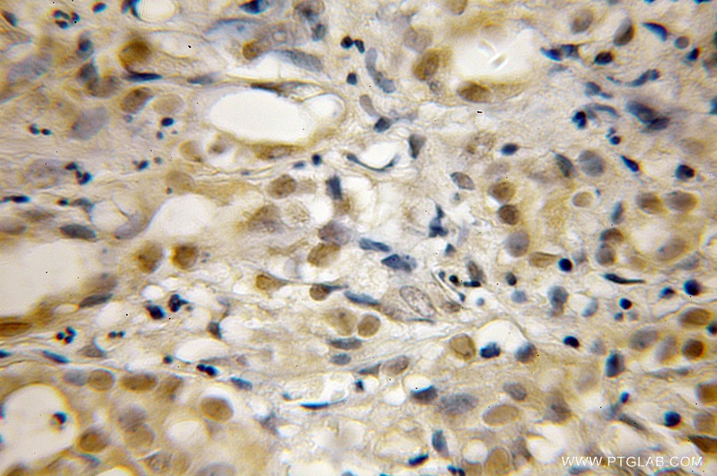 Immunohistochemistry (IHC) staining of human pancreas cancer tissue using RECQL5 Polyclonal antibody (12468-2-AP)