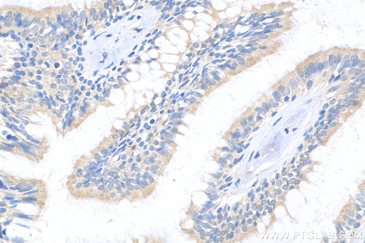 Immunohistochemistry (IHC) staining of human lung cancer tissue using REDD1 specific Polyclonal antibody (10638-1-AP)