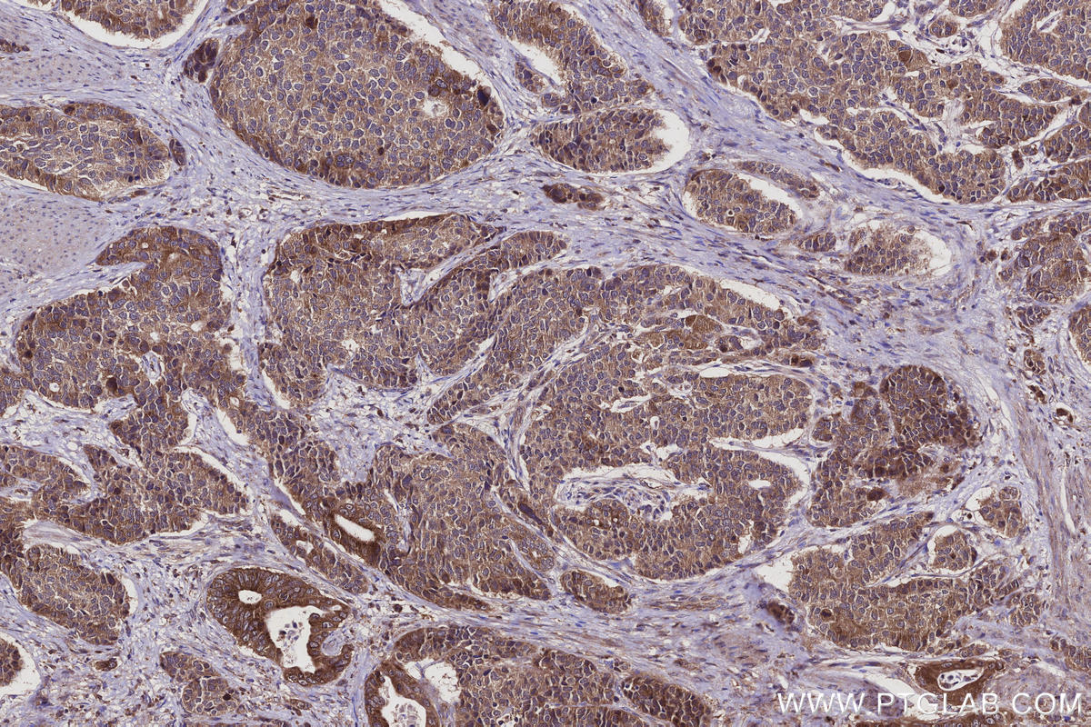 Immunohistochemistry (IHC) staining of human stomach cancer tissue using REEP4 Polyclonal antibody (26650-1-AP)