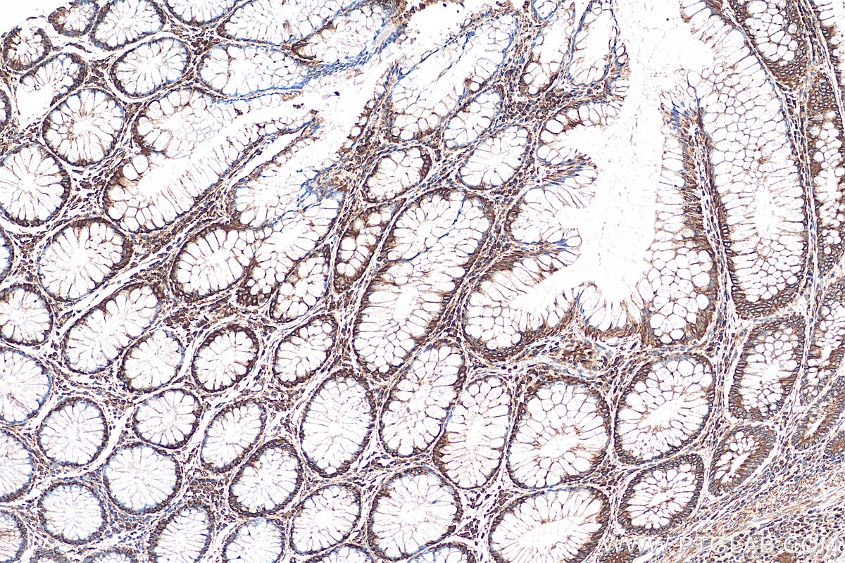 Immunohistochemistry (IHC) staining of human colon cancer tissue using REEP5 Polyclonal antibody (14643-1-AP)