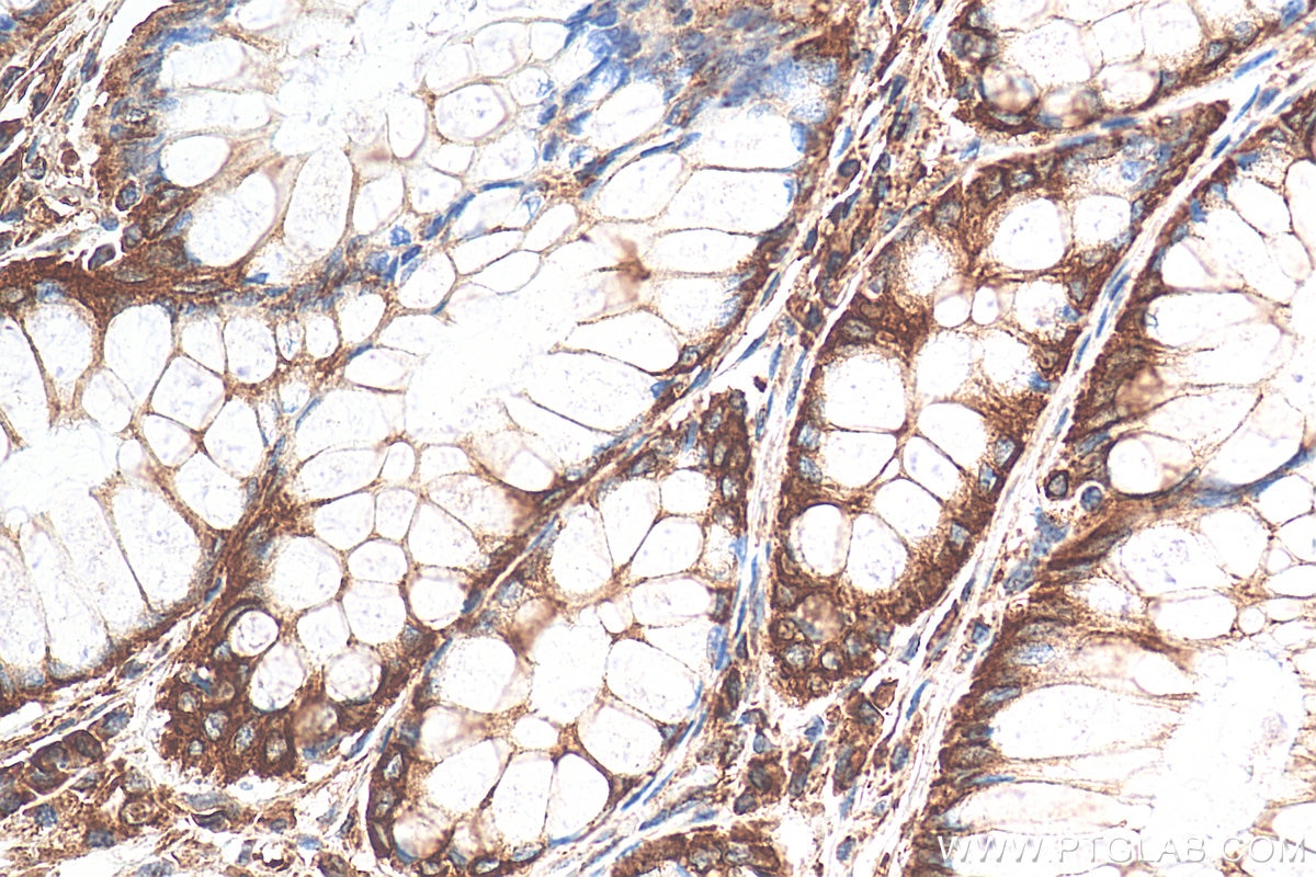 Immunohistochemistry (IHC) staining of human colon cancer tissue using REEP5 Polyclonal antibody (14643-1-AP)