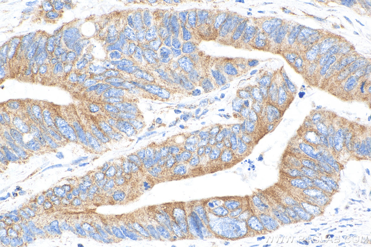 Immunohistochemistry (IHC) staining of human colon cancer tissue using REEP5 Monoclonal antibody (68119-1-Ig)