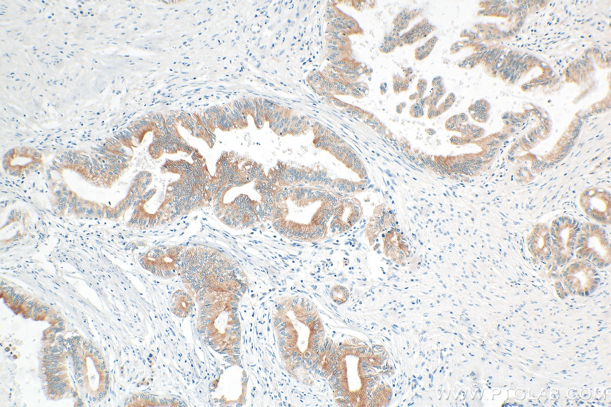 Immunohistochemistry (IHC) staining of human pancreas cancer tissue using REEP6 Polyclonal antibody (12088-1-AP)