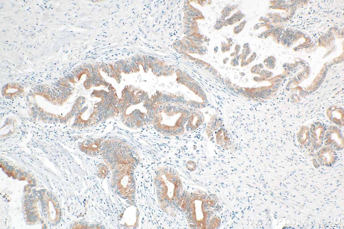 IHC staining of human pancreas cancer using 12088-1-AP