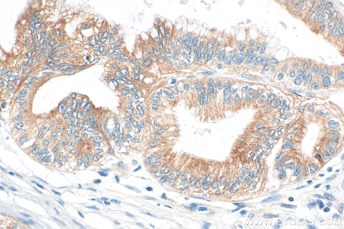 IHC staining of human pancreas cancer using 12088-1-AP