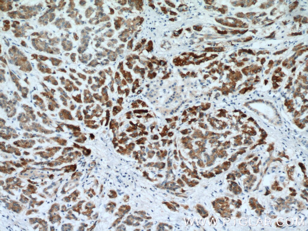 Immunohistochemistry (IHC) staining of human pancreas cancer tissue using REEP6 Polyclonal antibody (12088-1-AP)