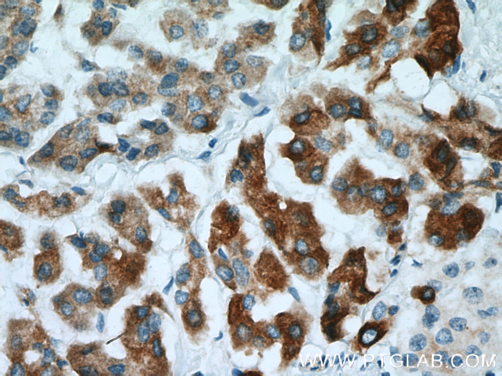 Immunohistochemistry (IHC) staining of human pancreas cancer tissue using REEP6 Polyclonal antibody (12088-1-AP)