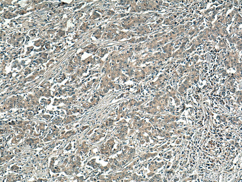 Immunohistochemistry (IHC) staining of human stomach cancer tissue using REG Polyclonal antibody (15850-1-AP)