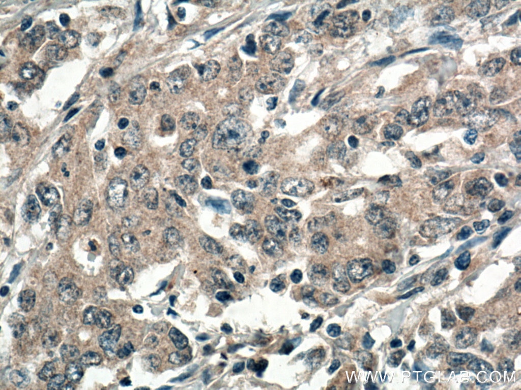 Immunohistochemistry (IHC) staining of human stomach cancer tissue using REG Polyclonal antibody (15850-1-AP)