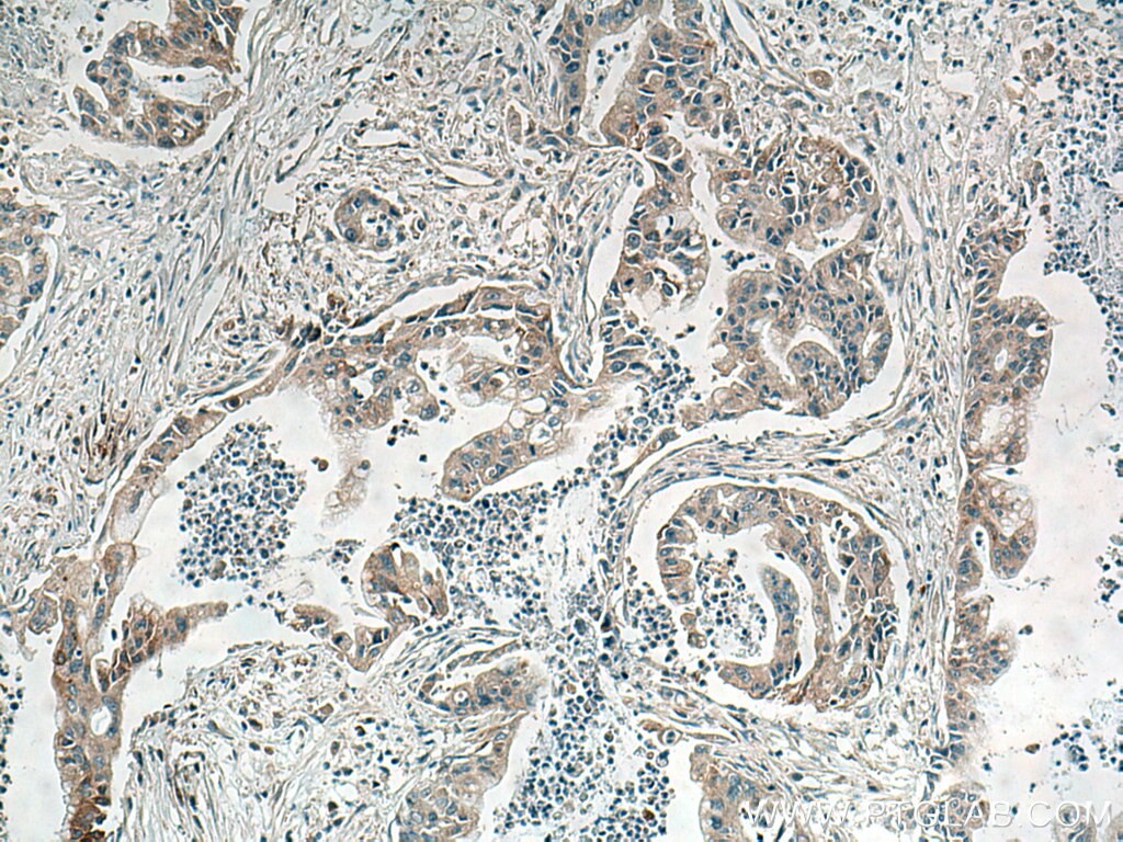 Immunohistochemistry (IHC) staining of human pancreas cancer tissue using REG Polyclonal antibody (15850-1-AP)