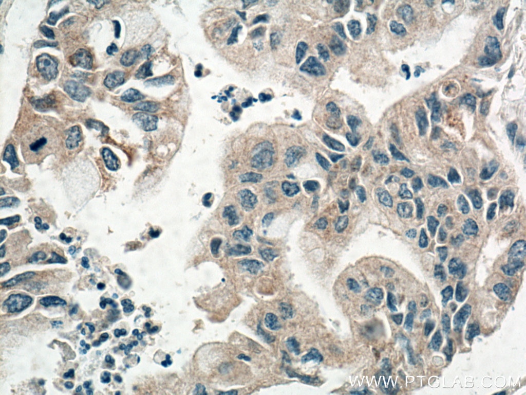 Immunohistochemistry (IHC) staining of human pancreas cancer tissue using REG Polyclonal antibody (15850-1-AP)