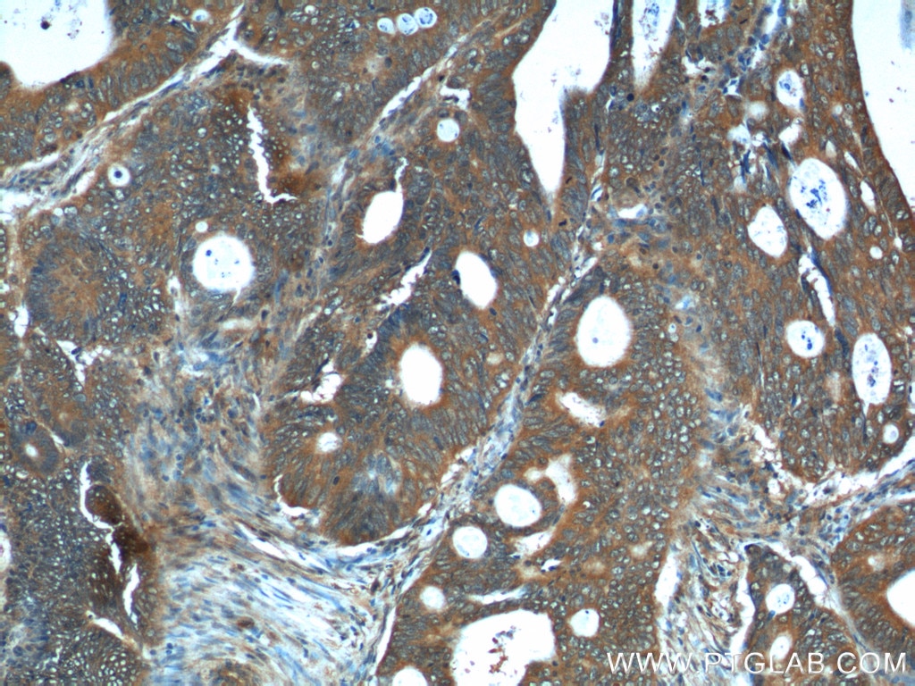 Immunohistochemistry (IHC) staining of human colon cancer tissue using REG4 Polyclonal antibody (12268-1-AP)