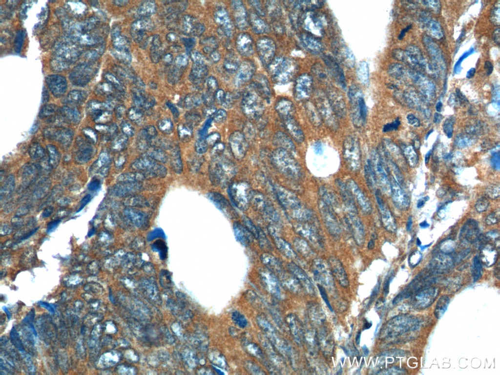 IHC staining of human colon cancer using 12268-1-AP