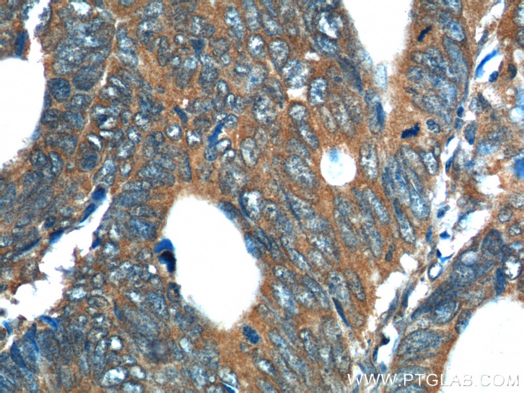 Immunohistochemistry (IHC) staining of human colon cancer tissue using REG4 Polyclonal antibody (12268-1-AP)