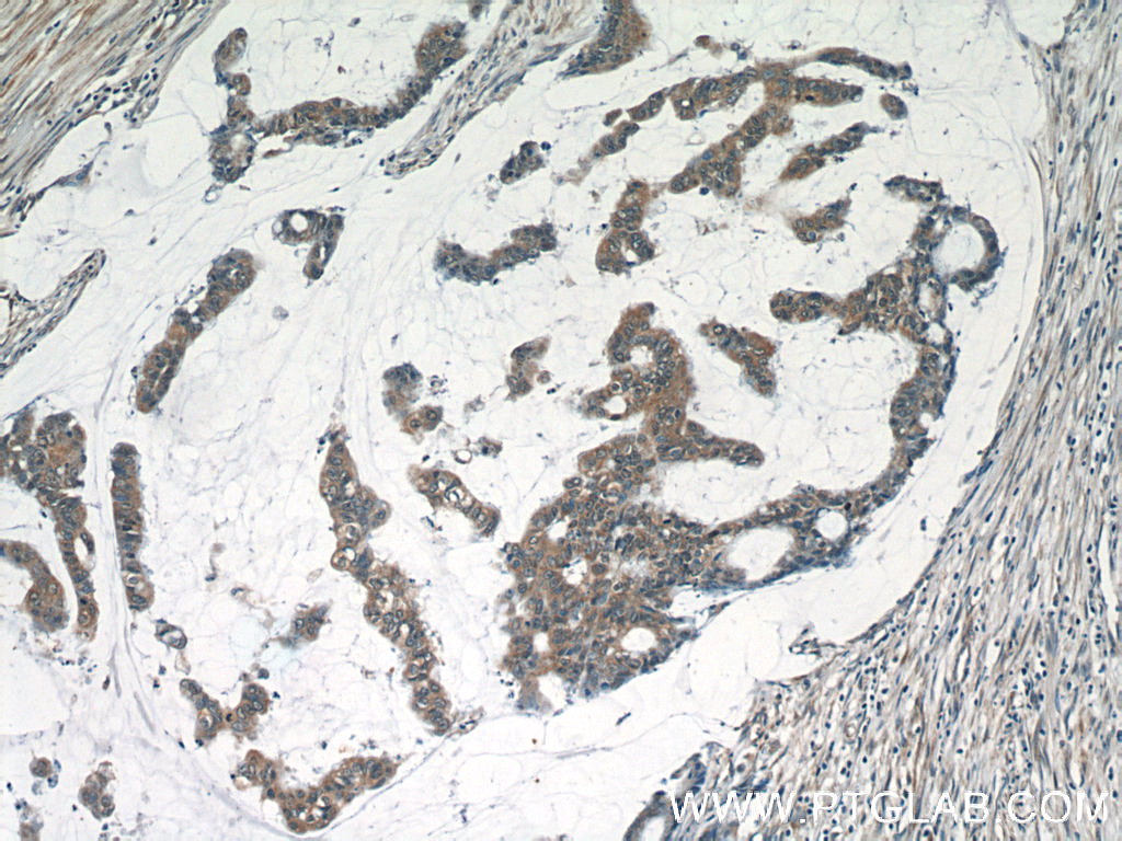 Immunohistochemistry (IHC) staining of human colon cancer tissue using RELB Polyclonal antibody (25027-1-AP)