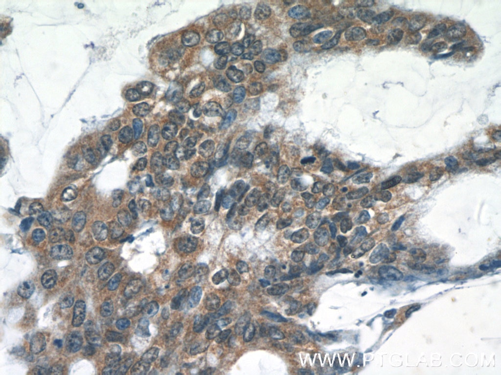 Immunohistochemistry (IHC) staining of human colon cancer tissue using RELB Polyclonal antibody (25027-1-AP)