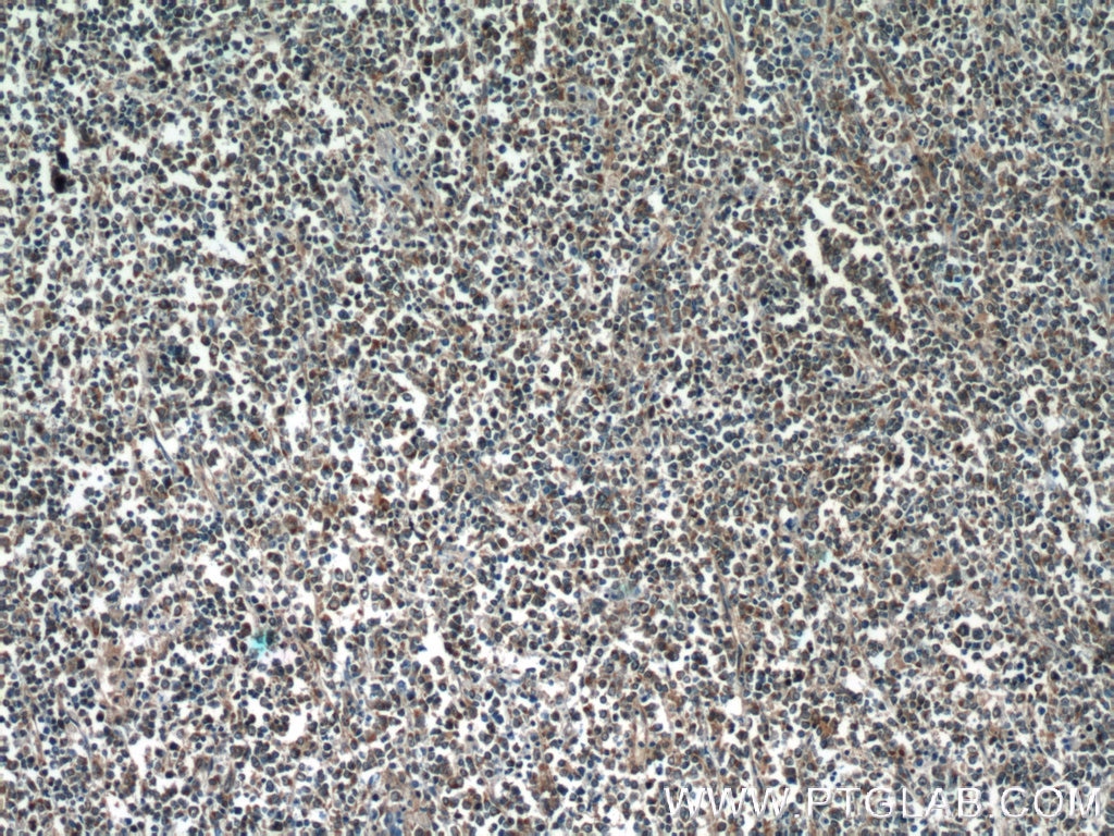 Immunohistochemistry (IHC) staining of human lymphoma tissue using RELB Polyclonal antibody (25027-1-AP)