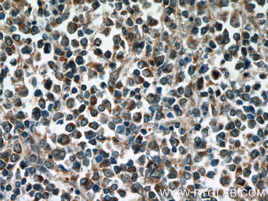 Immunohistochemistry (IHC) staining of human lymphoma tissue using RELB Polyclonal antibody (25027-1-AP)