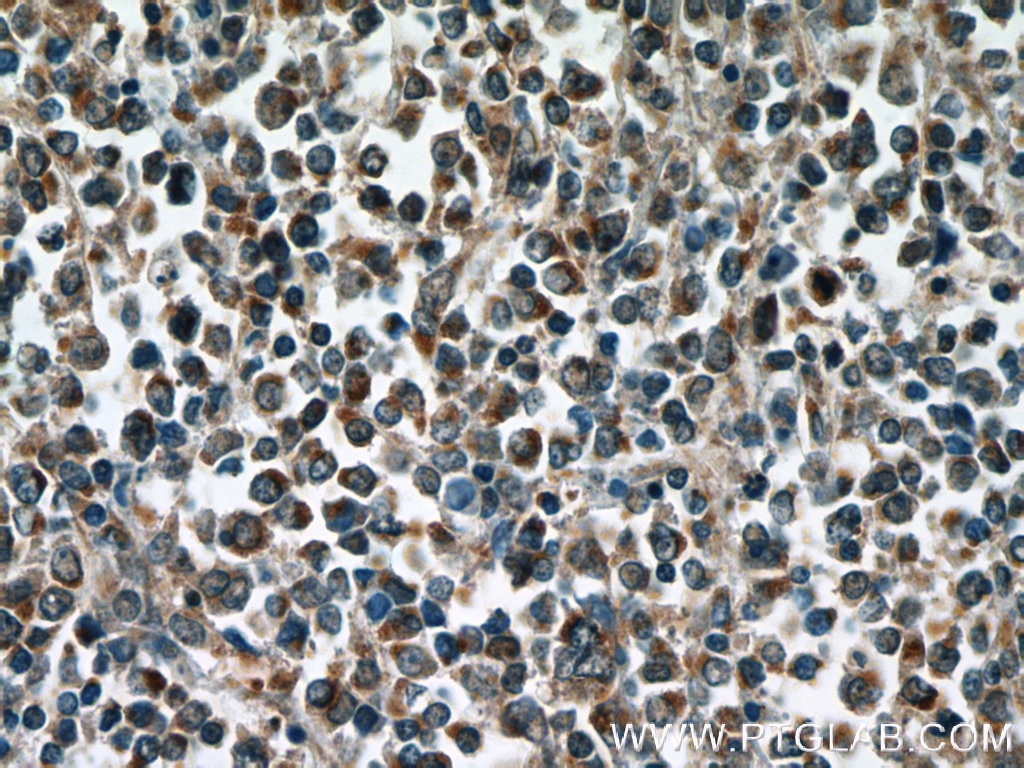 IHC staining of human lymphoma using 25027-1-AP