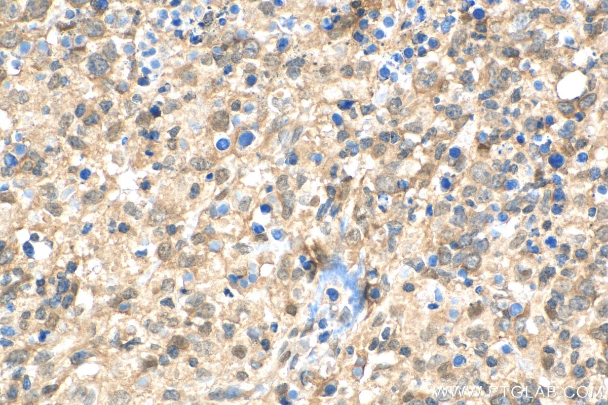 Immunohistochemistry (IHC) staining of human lymphoma tissue using RELB Polyclonal antibody (25027-1-AP)