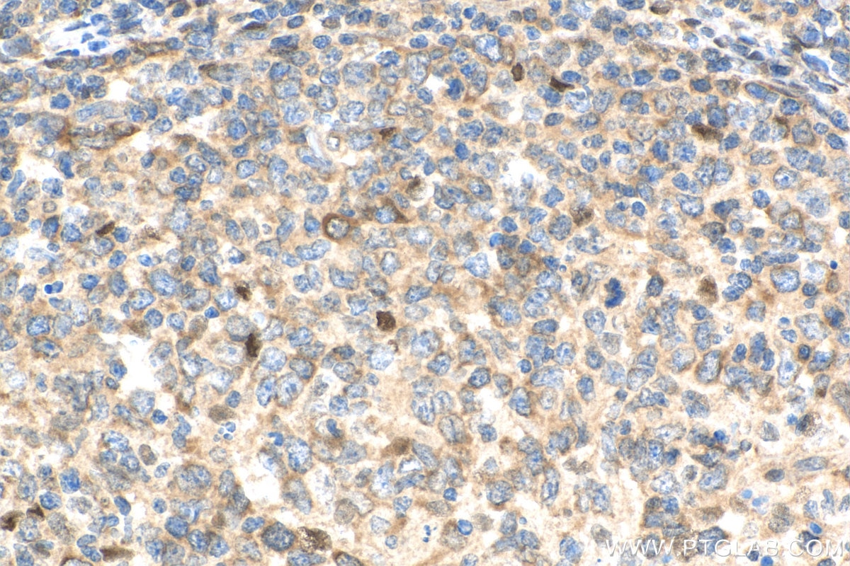 Immunohistochemistry (IHC) staining of human lymphoma tissue using RELB Polyclonal antibody (25027-1-AP)